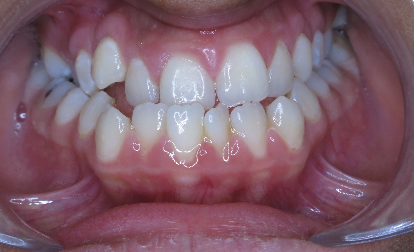 Before and After Oakridge Orthodontics Vancouver BC